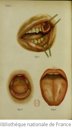 Atlas-manuel des maladies de la bouche, du pharynx et des fosses nasales / par le Dr L. Grünwald ; édition française par le Dr Georges Laurens,...