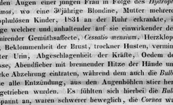 BASEDOW, Carl Adolph von (1799-1854) Exophthalmos durch Hypertrophie des Zellgewebes in der Augenhöle