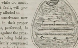 SIMS, James Marion (1813-1883) On the treatment of vesico-vaginal fistula