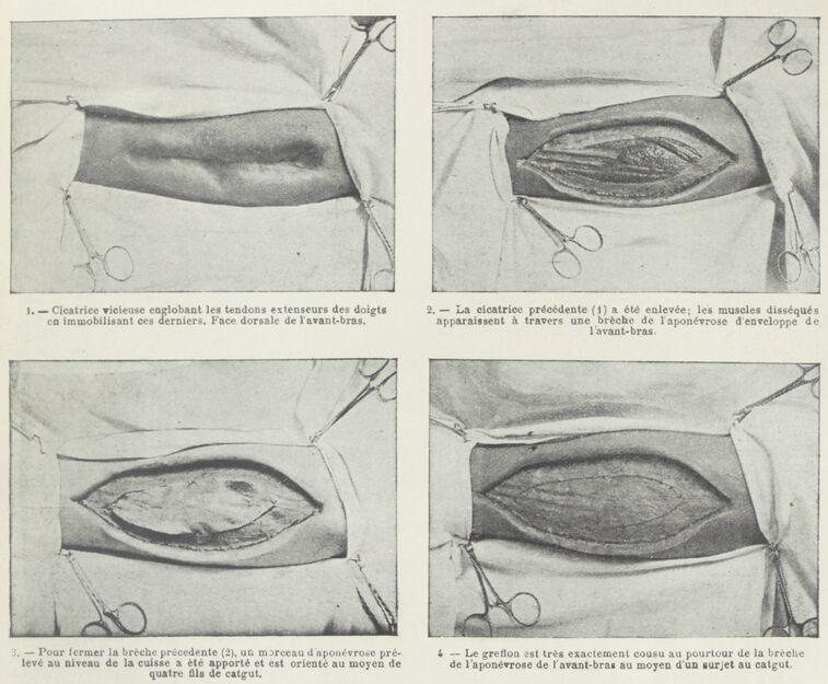 Larousse médical illustré de guerre par le Docteur Galbier Boissière (source : BNF Gallica)